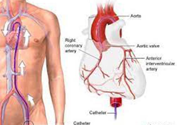 coronary-angiography