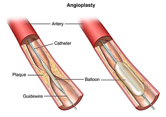 coronary-angioplasty