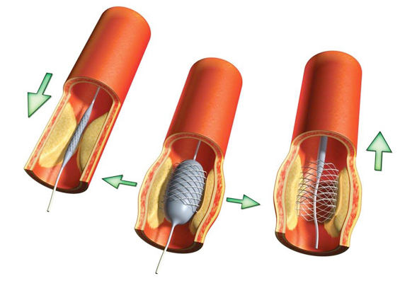 tavr