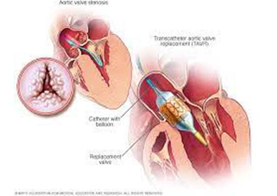 tavr